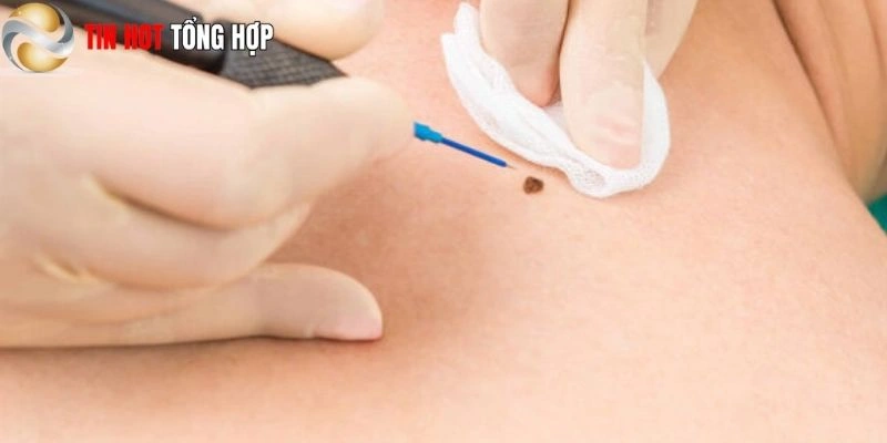 Cải thiện tướng số qua việc chăm sóc nốt ruồi đúng cách