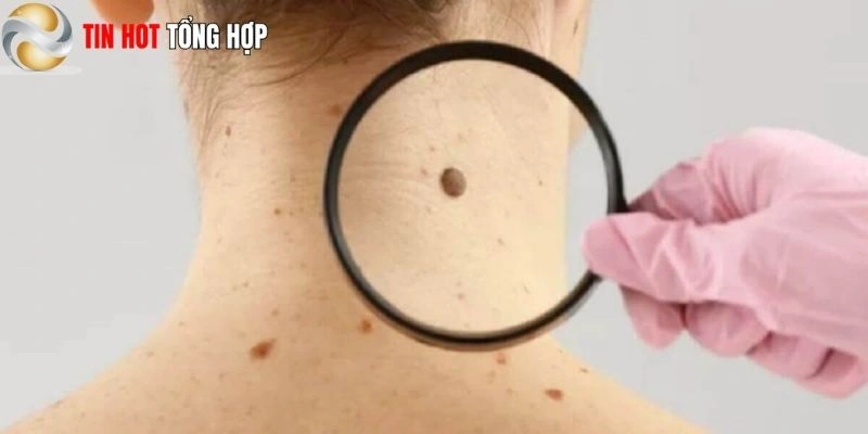 Tẩy nốt ruồi – Những ảnh hưởng đến tướng số và cuộc sống của bạn